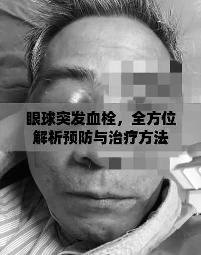 眼球突发血栓,全方位解析预防与治疗方法