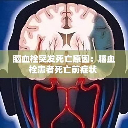 脑血栓突发死亡原因:脑血栓患者死亡前症状