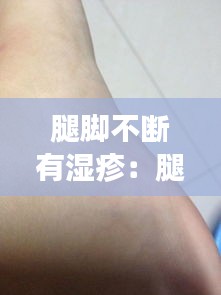 腿脚不断有湿疹:腿有湿疹怎么回事