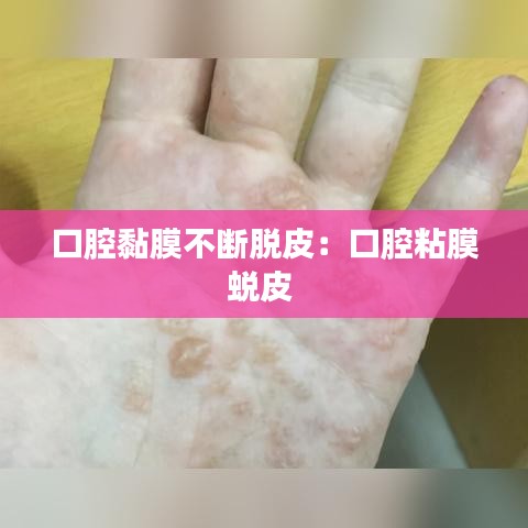 口腔黏膜不断脱皮:口腔粘膜蜕皮