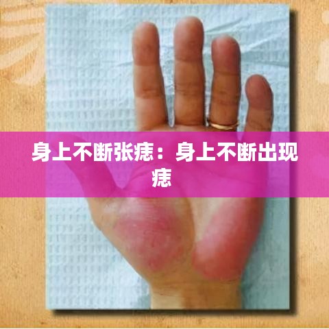 身上不断张痣:身上不断出现痣