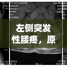 左侧突发性腰疼,原因、症状及治疗方法详解