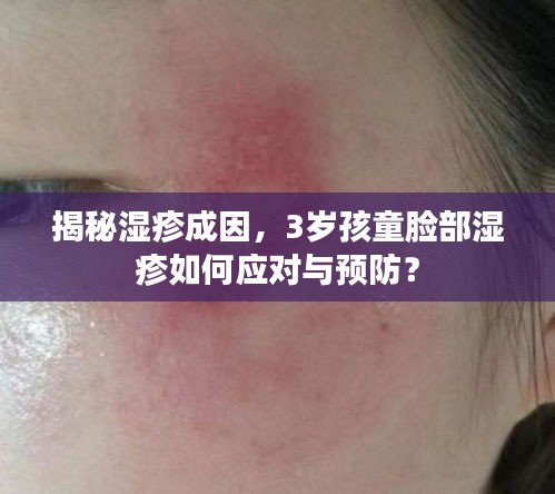 揭秘湿疹成因,3岁孩童脸部湿疹如何应对与预防?